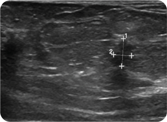 small breast lesion under ultrasound